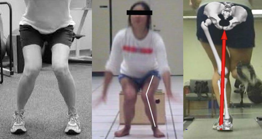 Do hip-abduction braces work?—A biomechanical evaluation of a